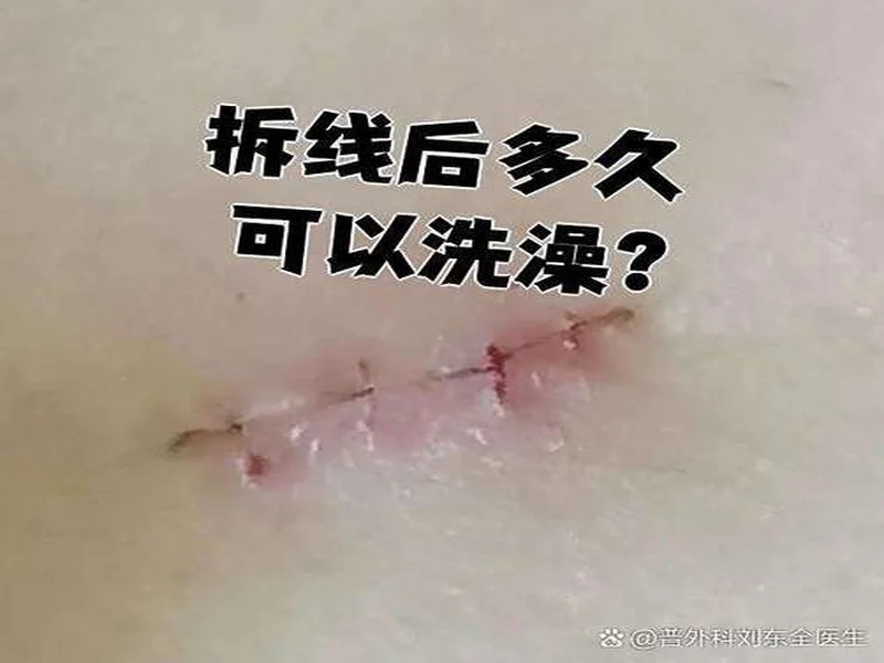 广州豹官方：杨浩眉弓伤口缝合30余针，预计5-7天后拆线